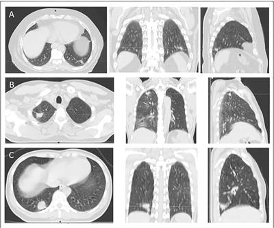 High-risk patients with locally advanced non-small cell lung cancer treated with stereotactic body radiation therapy to the peripheral primary combined with conventionally fractionated volumetric arc therapy to the mediastinal lymph nodes